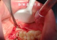 实拍拔智齿全过程
