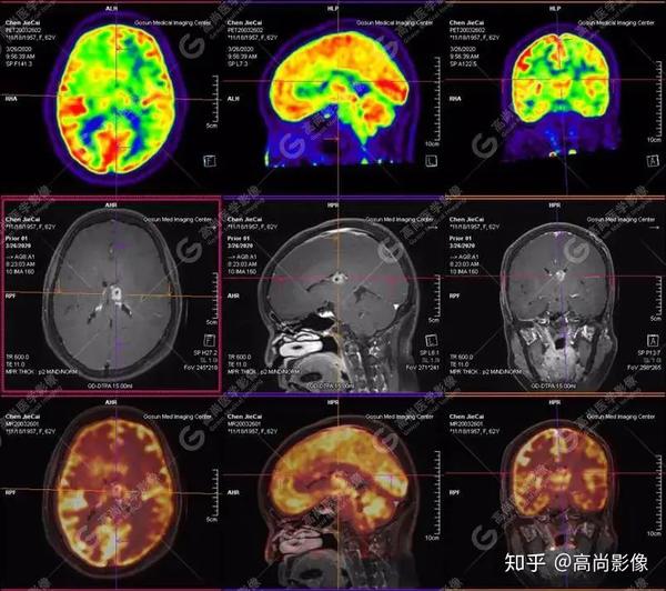 【高尚医疗影像【多模态影像】颅内淋巴瘤pet-mr融合显像1例