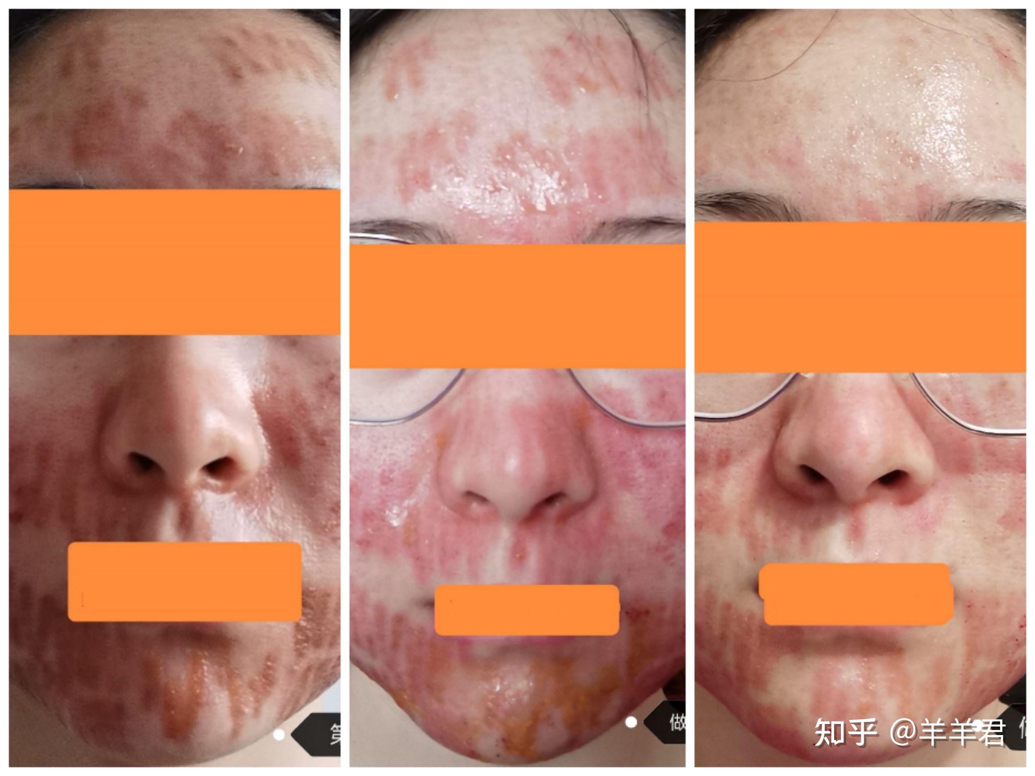 剥脱去痘坑记录超级平台铒激光