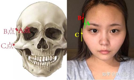 一文教你看懂 你到适合颧骨内推