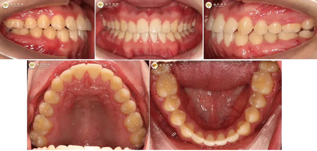 正畸病例地包天二次矯正病例1例