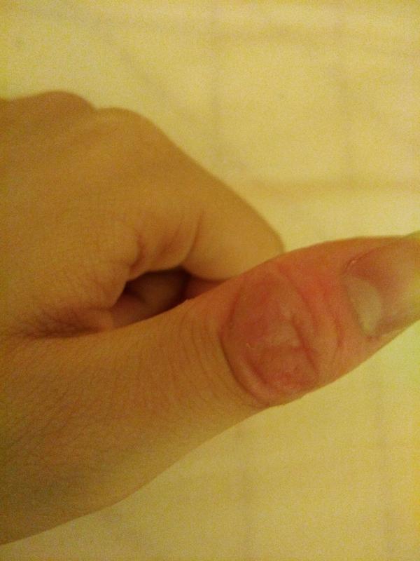 如何控制不自觉的没完没了的撕手皮如何恢复手指皮肤的状态比如已经撕