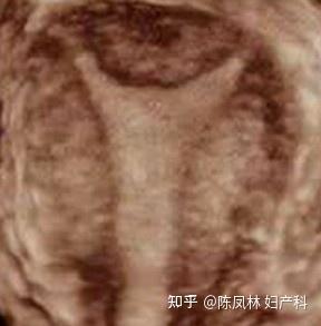 什么是双角子宫？ - 知乎