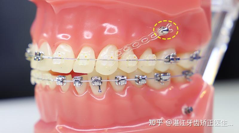 牙齿矫正打骨钉图片