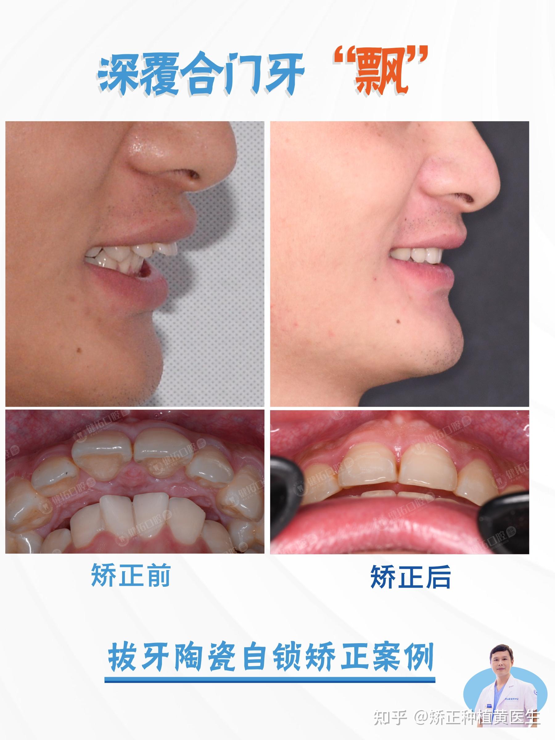 深覆合+牙齿外“飘”的矫正案例 - 知乎
