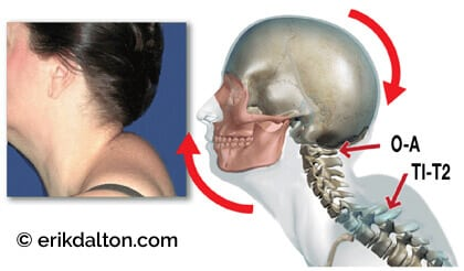 富贵包,颈后有个大包,颈椎病前兆,如何1个月消除它?
