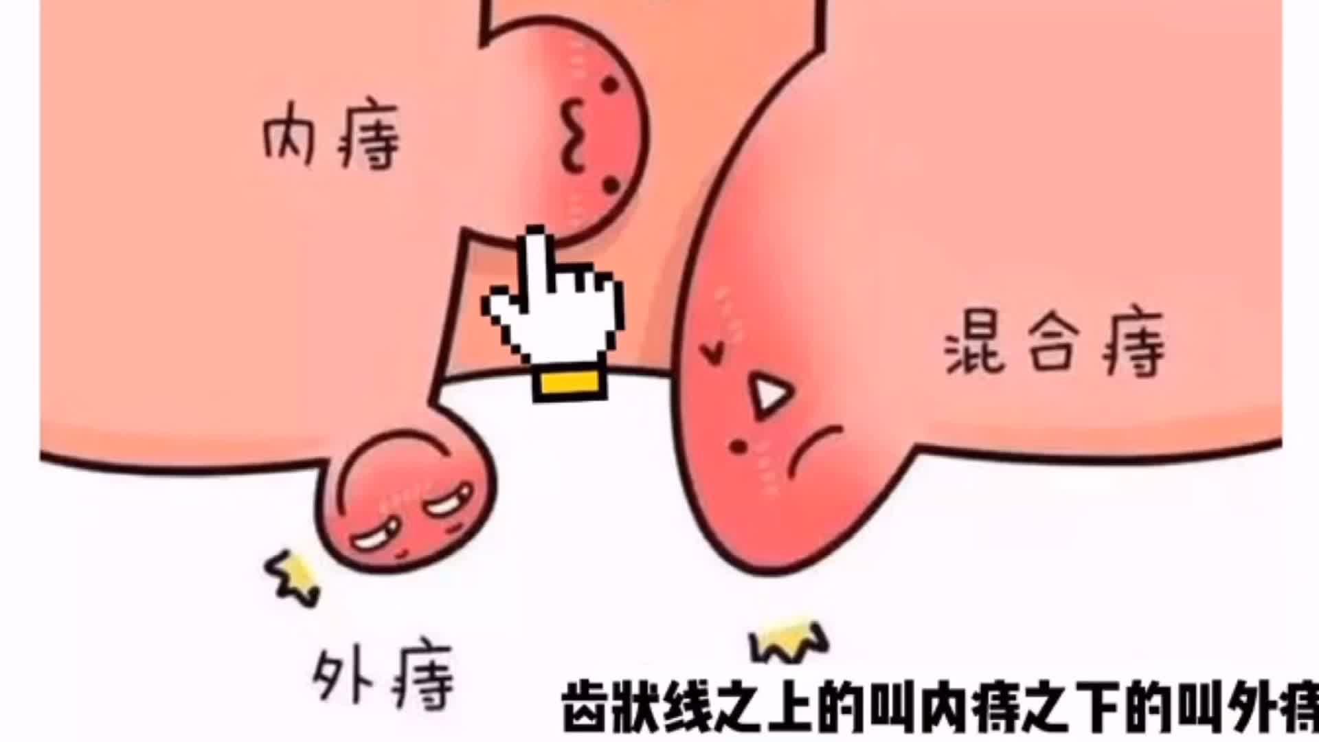 痔疮的原因