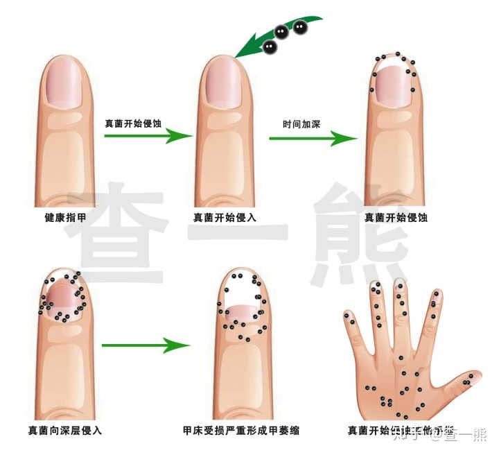 治疗灰指甲亮甲好用还是楚甲
