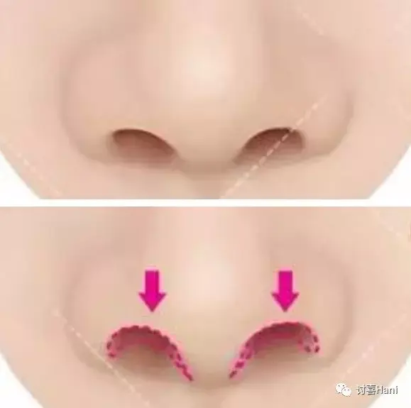 网红方恰拉成为整形模板却躲不过挛缩鼻的命运