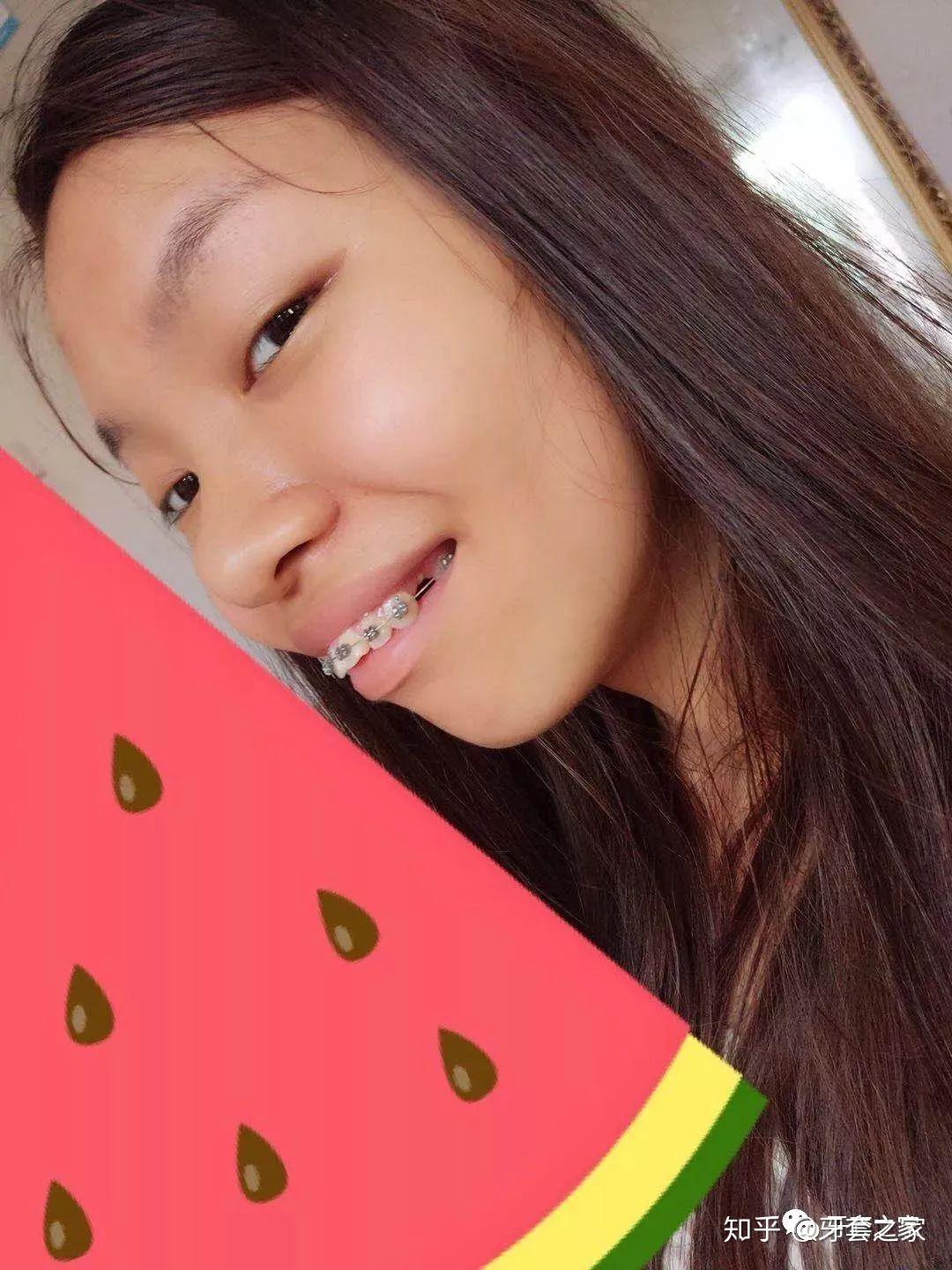 牙齿突,门牙要飞出去了.拔了八颗牙齿,谢谢牙套让我自信