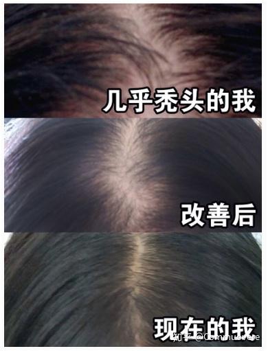 治疗毛囊炎最有效的方法 - 知乎