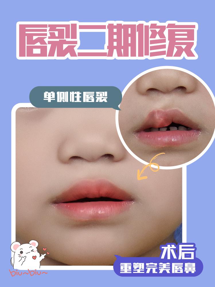 隐性唇裂不明显可以不治疗吗