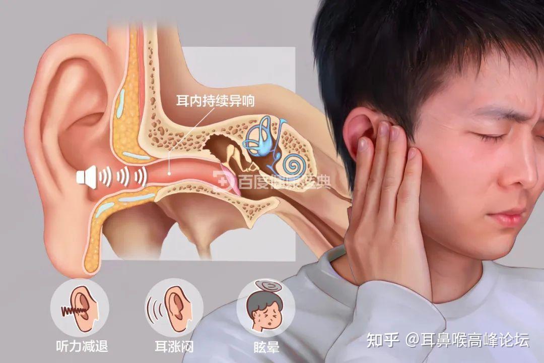 又该用什么专业疗法来治疗呢?01耳鸣是怎么回事?在临床上,耳鸣