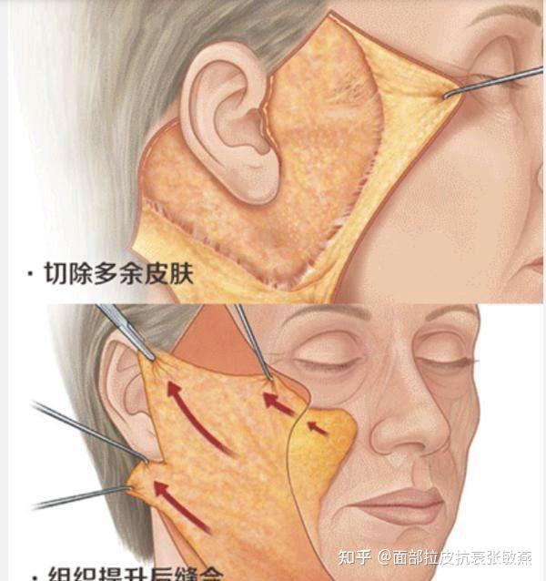 拉皮面部剥离范围越大最后的效果越好是真的吗