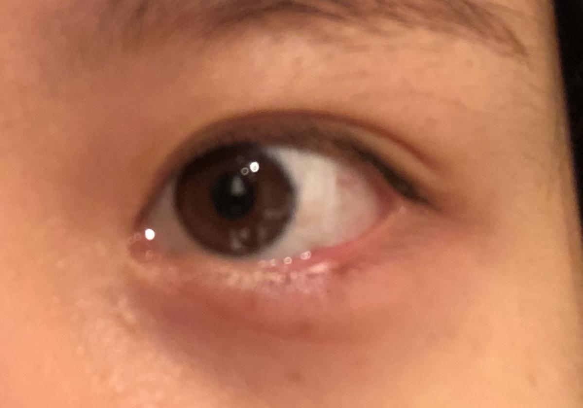 右眼眼角（大眼角）下面长了一个红疙瘩很疼，很痒，跟肿了似的，怎么办？_百度知道
