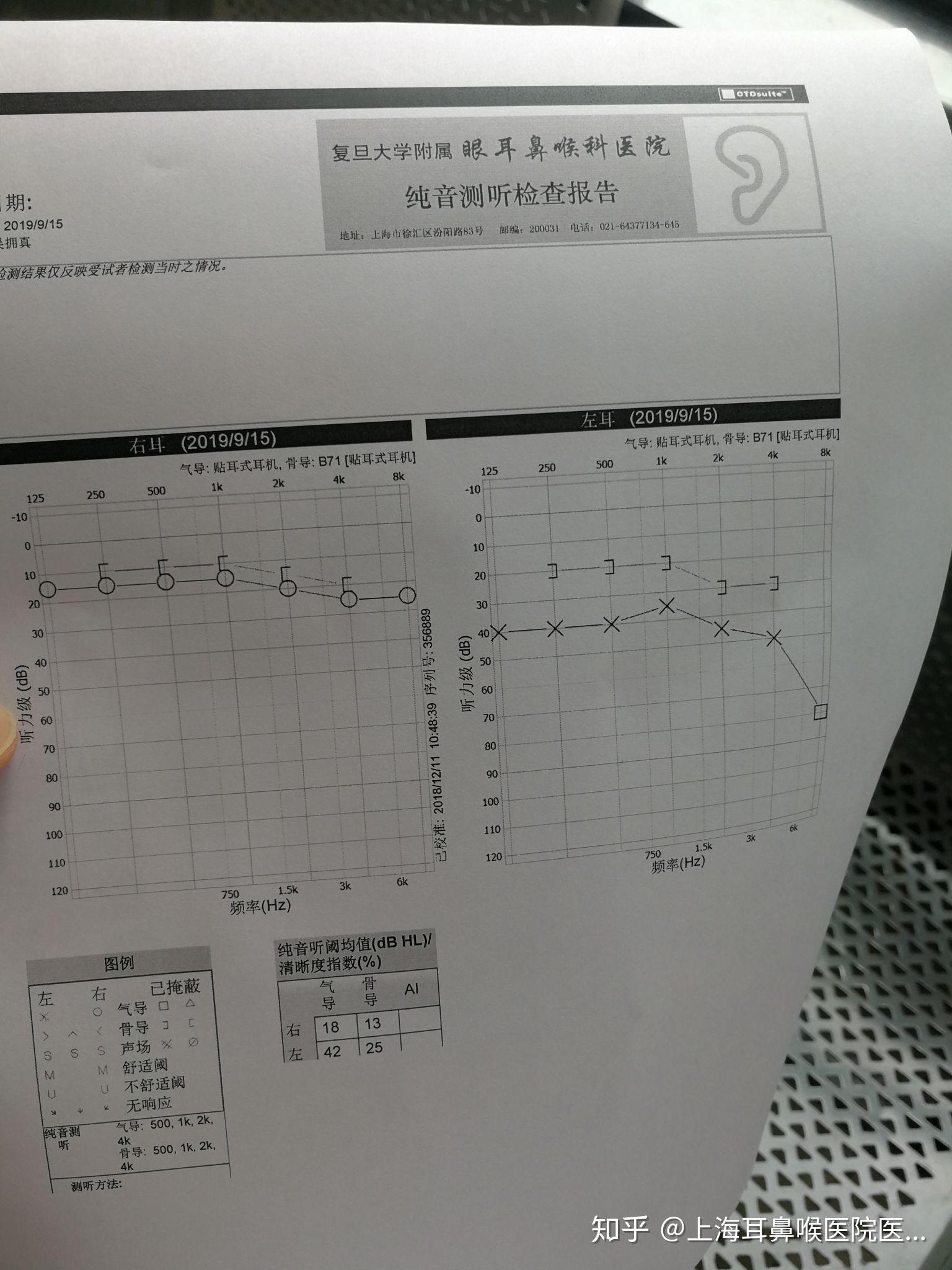 我在上海耳鼻喉科医院耳道冲洗导致耳膜穿孔终身无法恢复