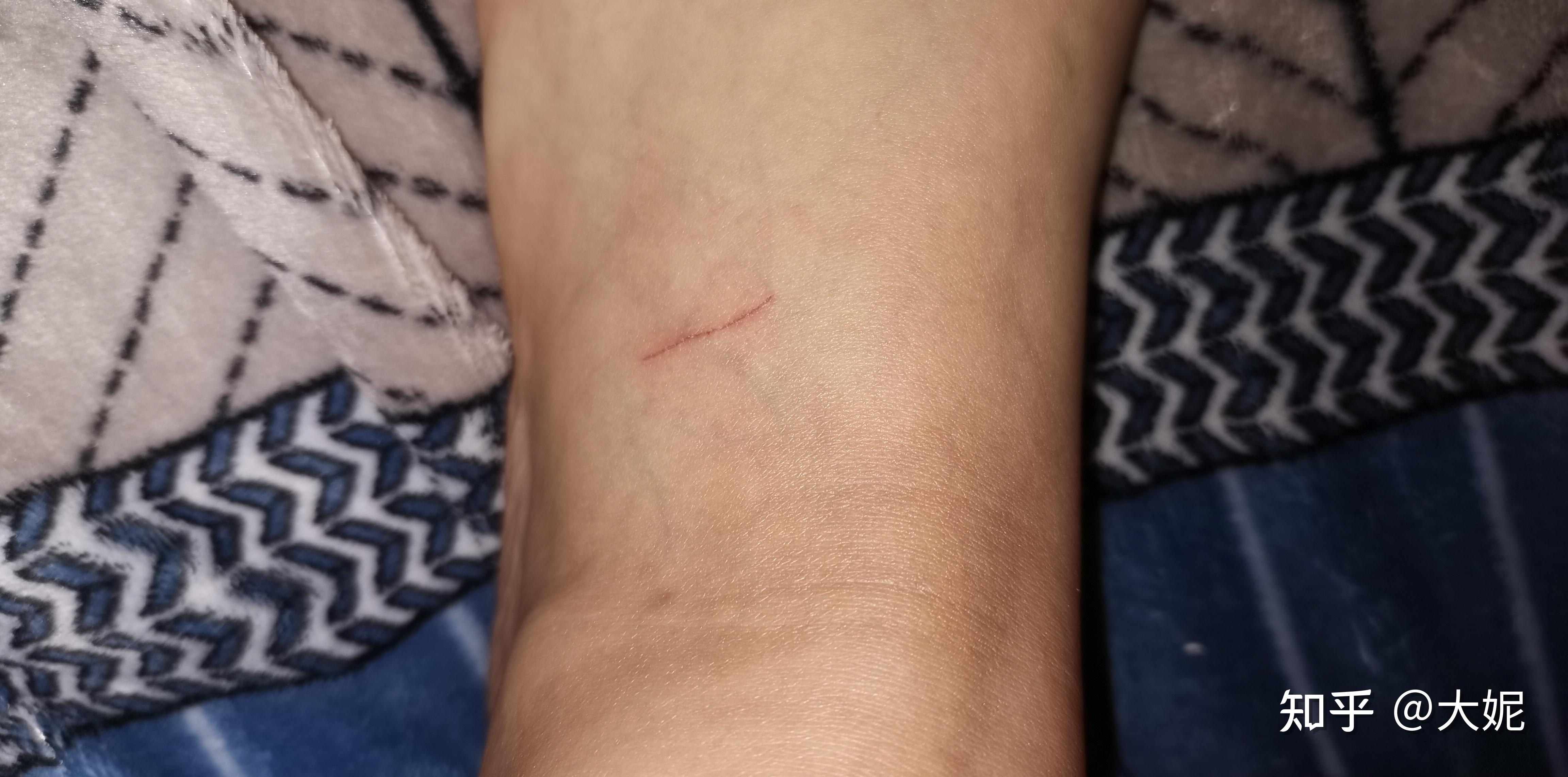 月的小猫玩的时候被抓伤(小猫的妈妈是小区里的流浪猫)伤口已挤血冲洗