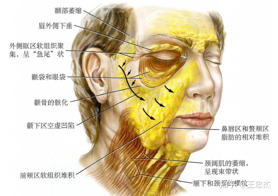 面部软组织容量缺失的症状有哪些?