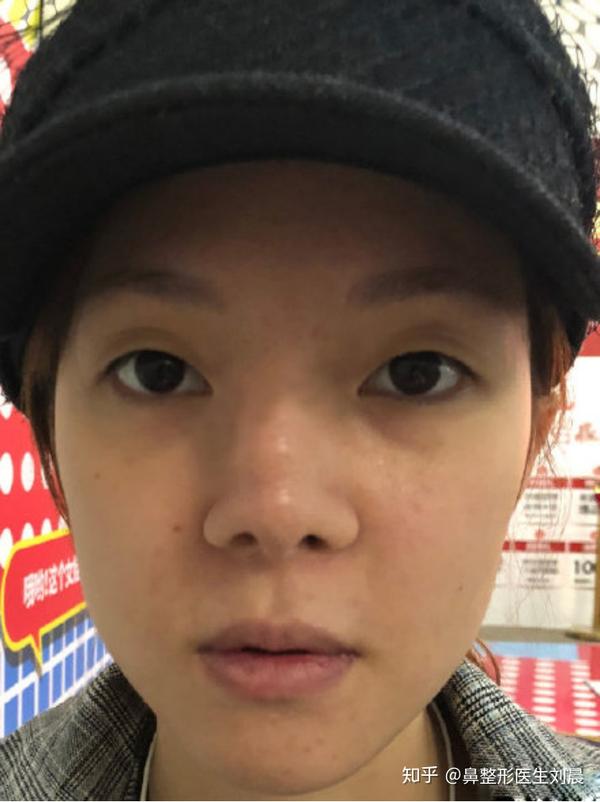 案 例 三: 下面这位小姑娘,鼻子短,小,塌,导致的眼距更宽 ,真的很"