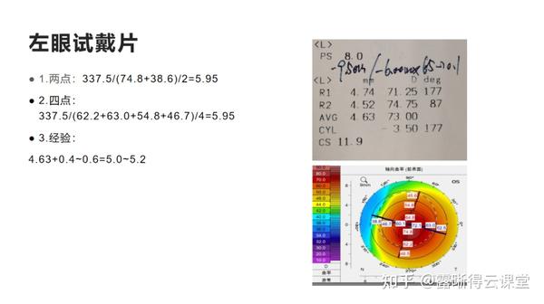 圆锥角膜的RGP验配及RGP临床效果分析（文字版） - 知乎