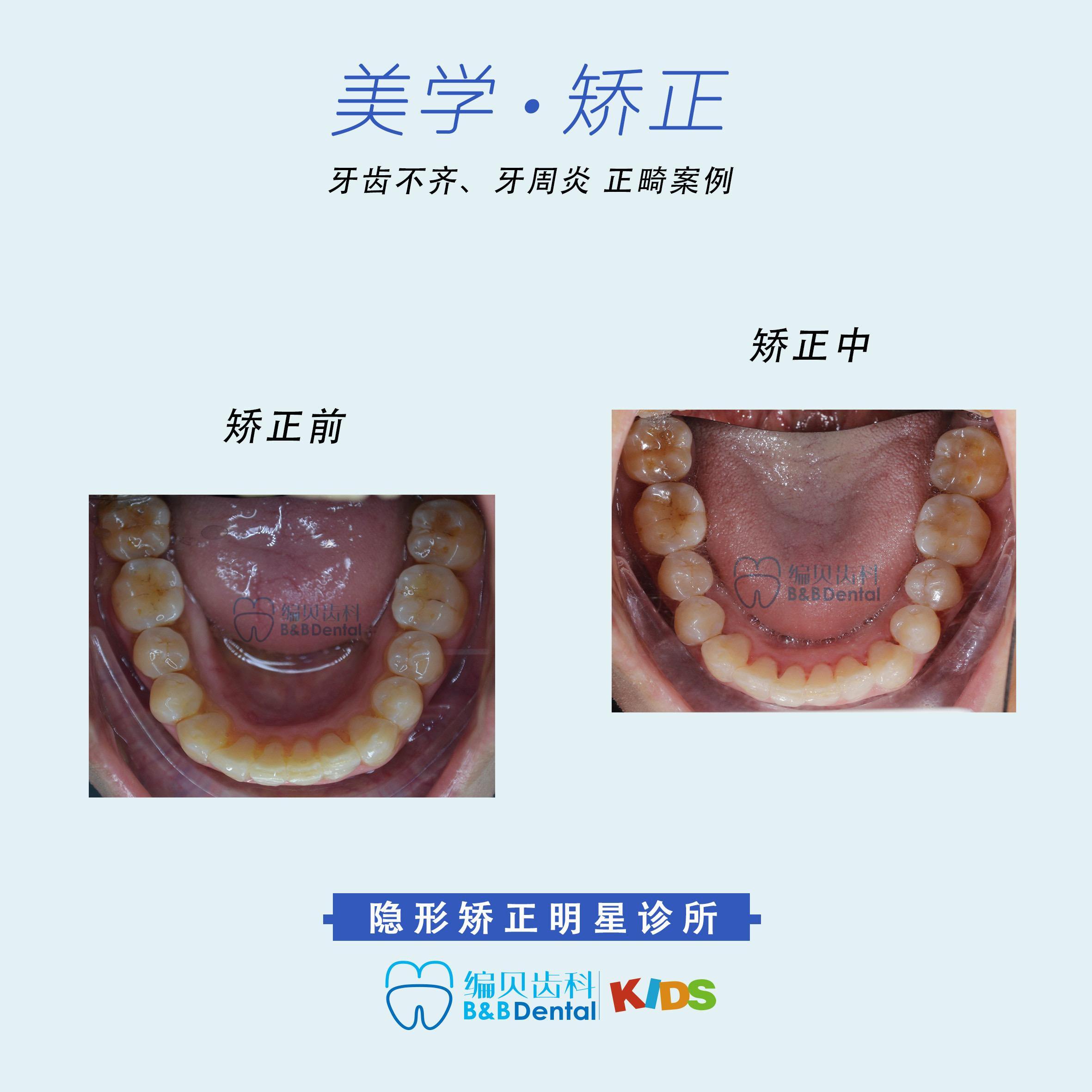 鄭州隱適美矯正牙周炎可以正畸嗎