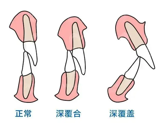 牙齿矫正