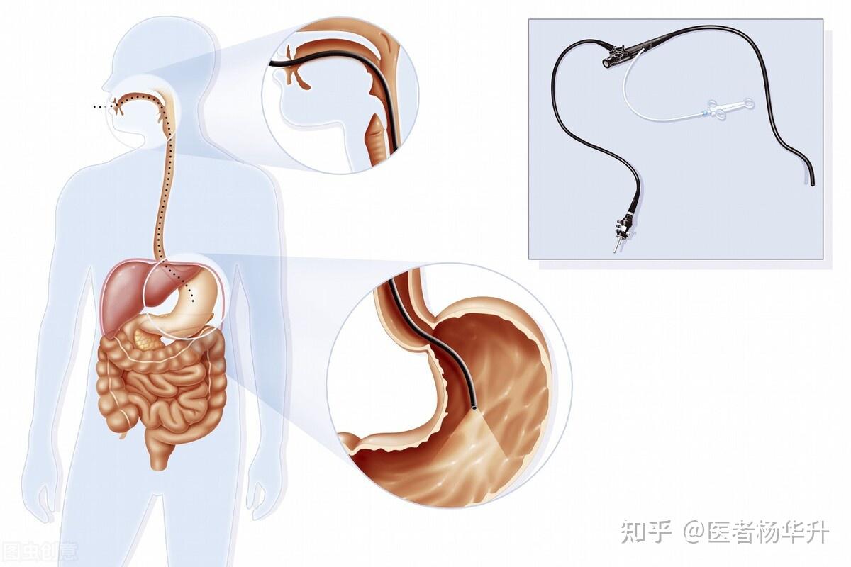 上消化道出血很兇險權威醫生提醒肝病患者重視胃鏡檢查