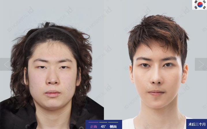 Let 美人 面部轮廓手术案例分析 知乎