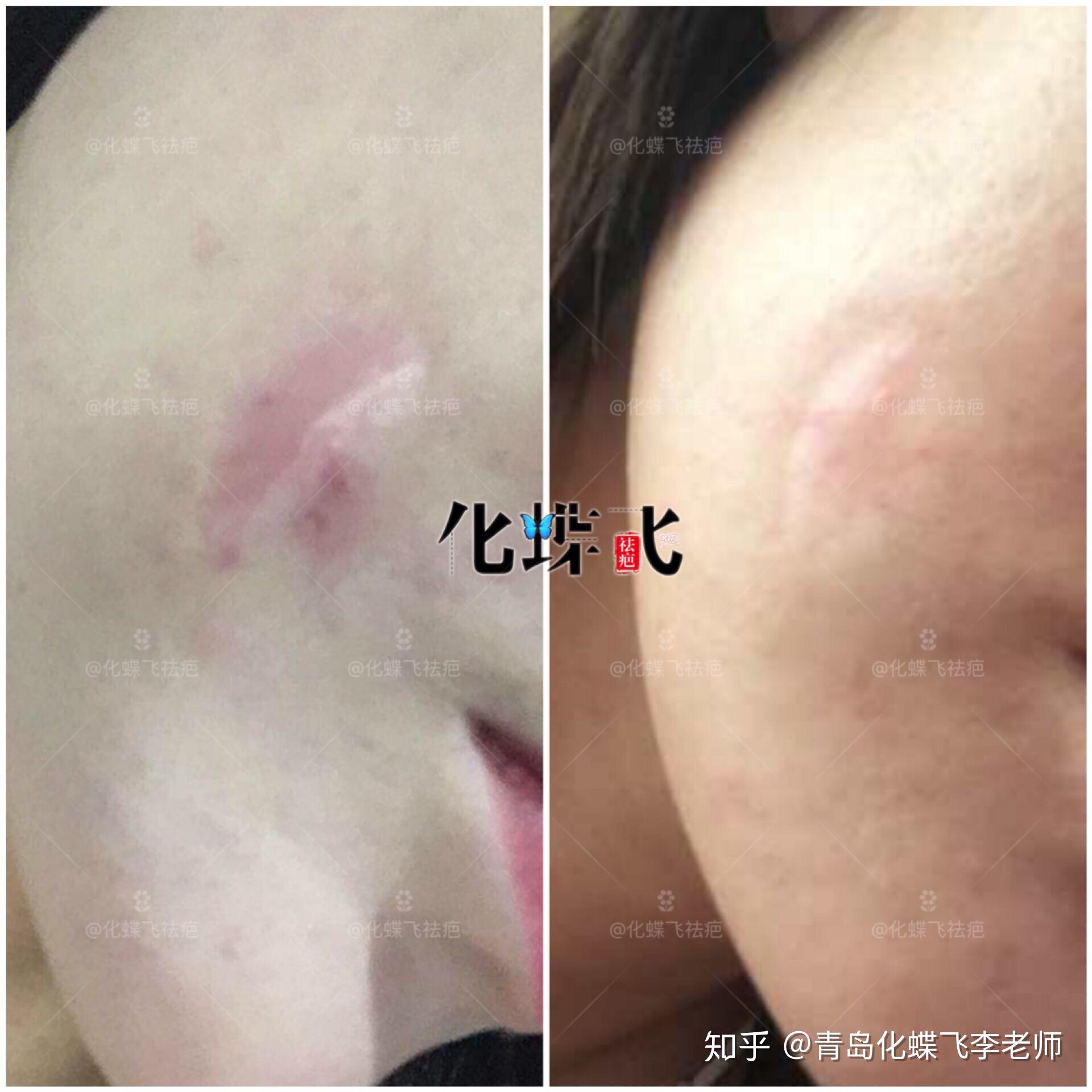 使用中藥進行疤痕修復,結痂掉痂代謝兩次,疤痕平復了很多,軟了很多,也