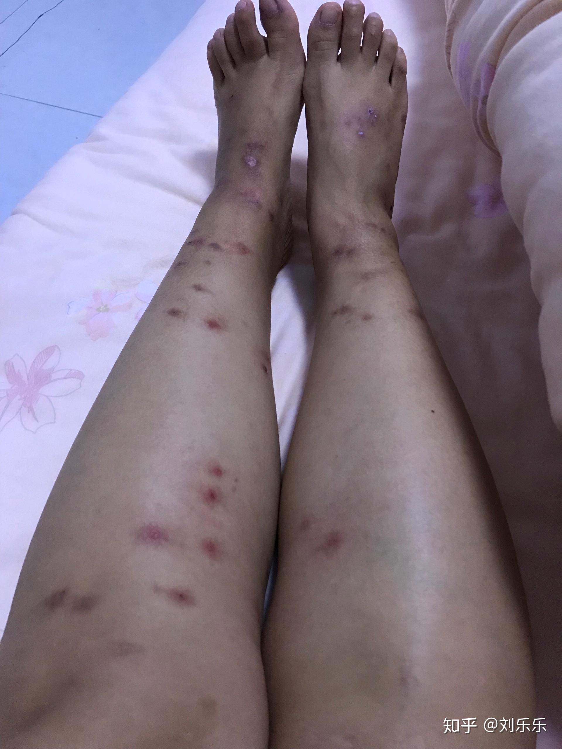 被跳蚤咬过的腿