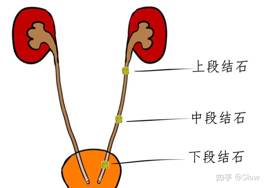 肾结石往下排的过程图图片