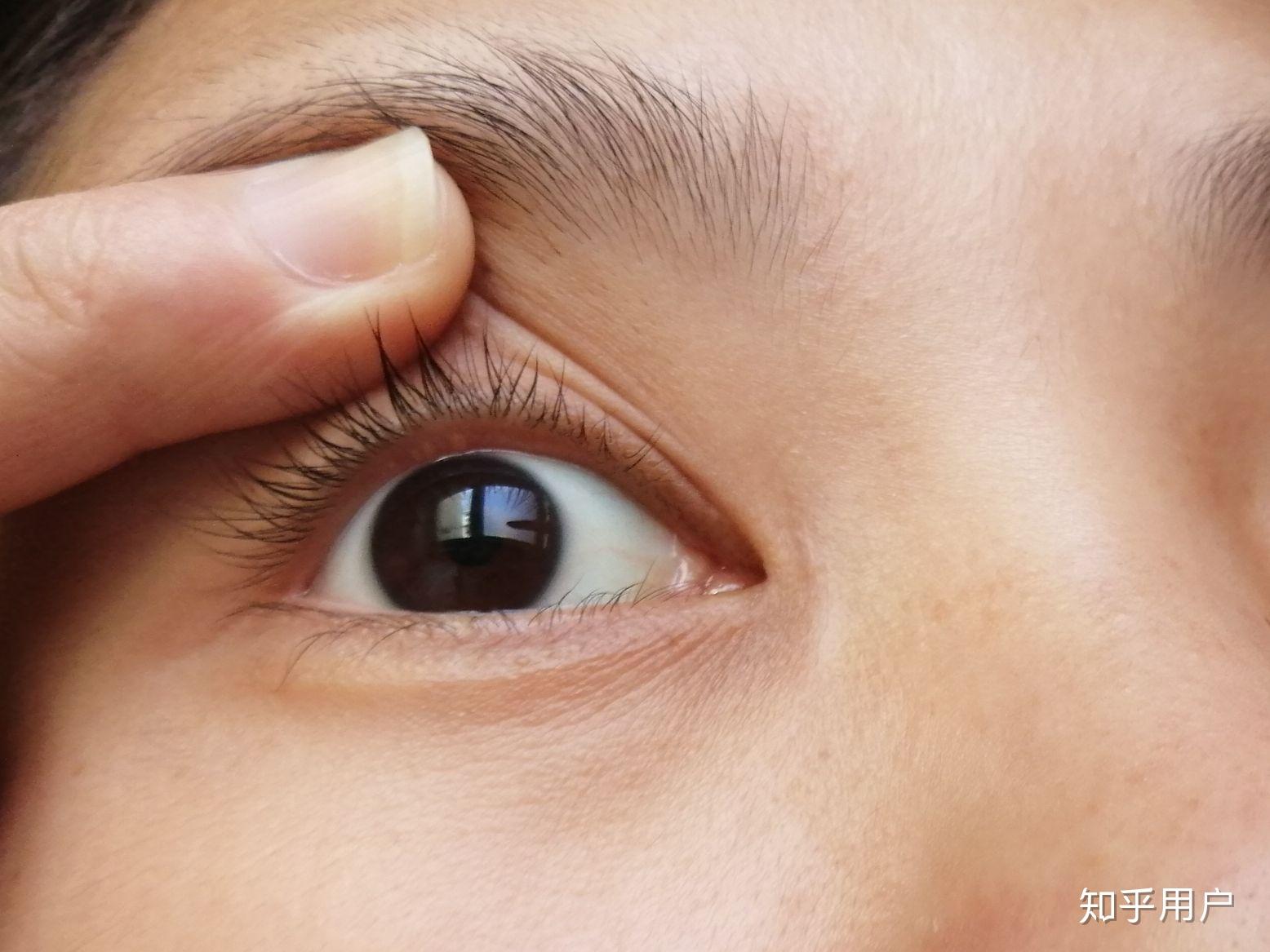 眼睑起了个小泡是怎么了?如图? - 知乎