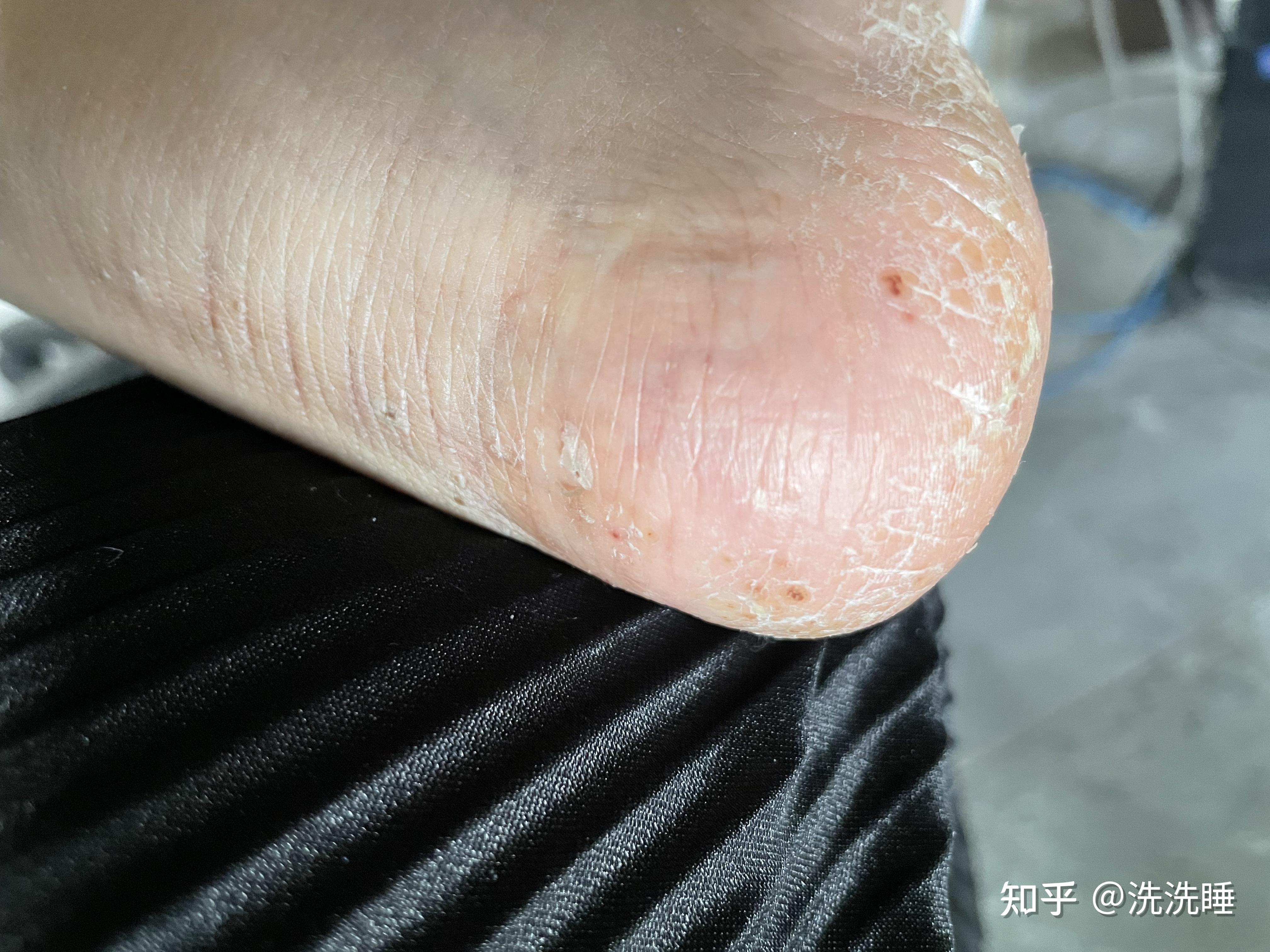 掌跖脓疱病略有好转