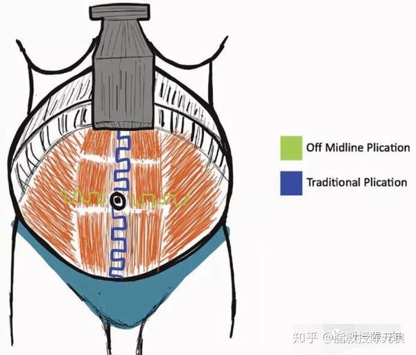 腹壁整形简介