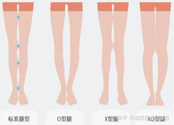 告别膝关节损伤,下肢力线很重要|海思康运动医学诊所 - 知乎