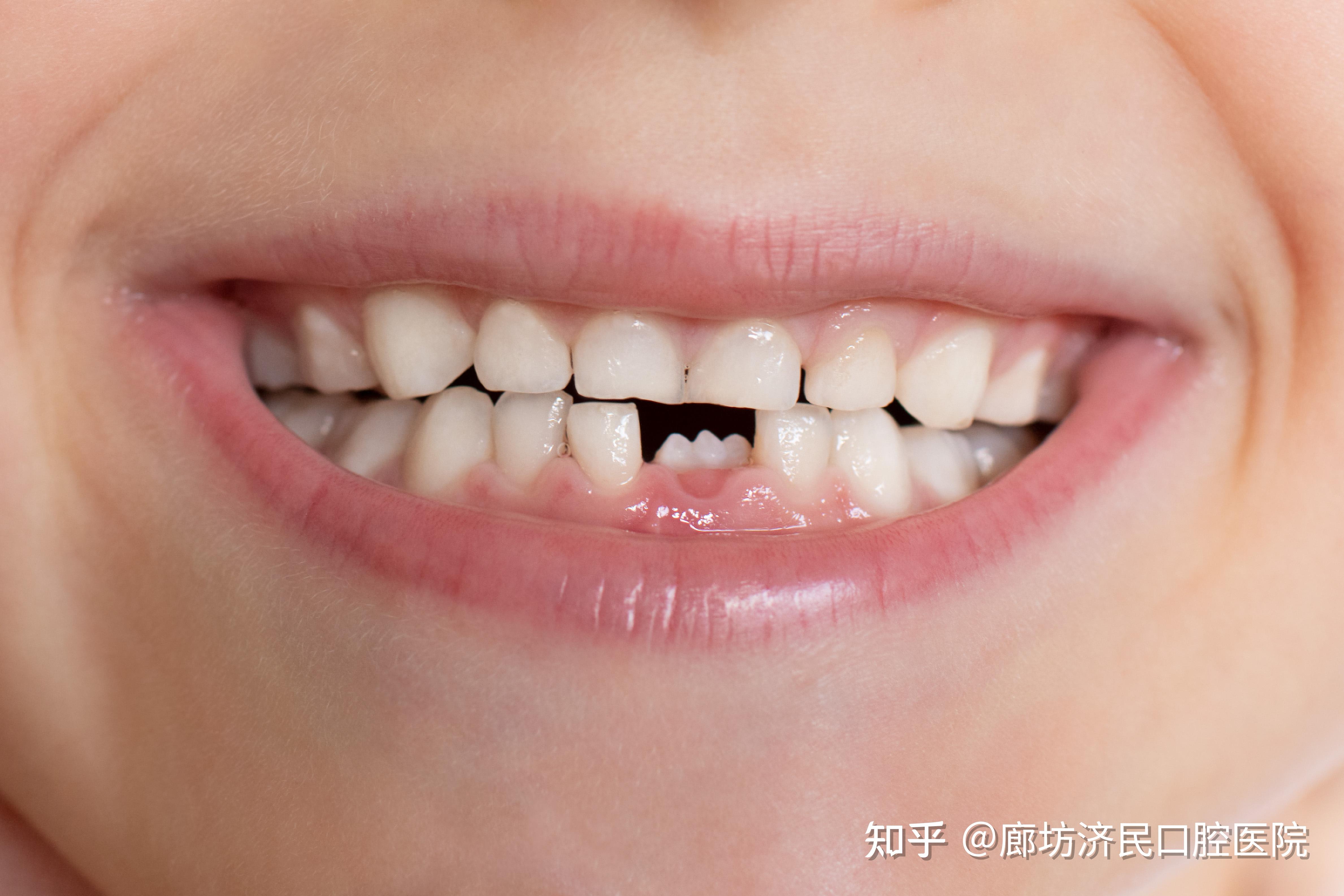 【附图】 S-ECC儿童广泛的右下第二乳磨牙龋坏及尚未完全萌出的右下第一恒磨牙龋坏 _口腔医学 | 天山医学院