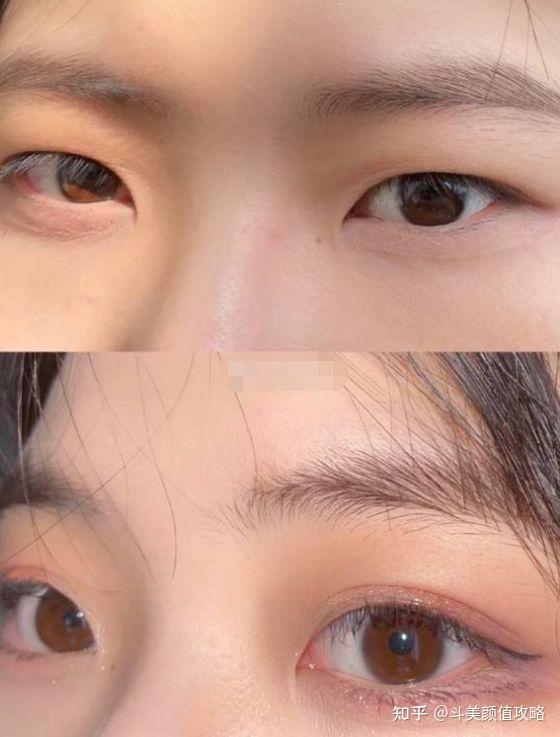 合肥做双眼皮一般需要多少钱啊?