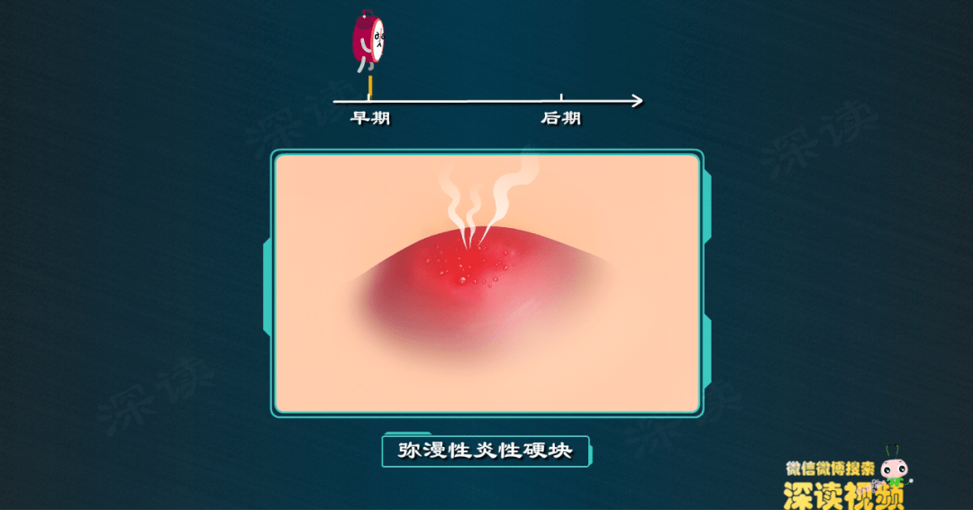 身上长痘痘小脓疱没事超短裙谁穿谁尴尬毛囊炎究竟是个啥