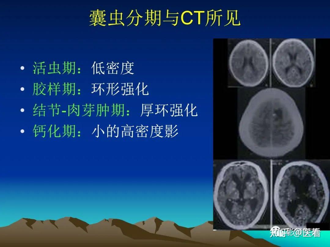 腦囊蟲病的診斷與鑑別