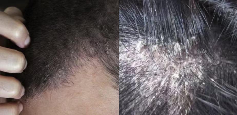 你以为只是头皮痒?脂溢性皮炎让你防不胜防 - 知乎