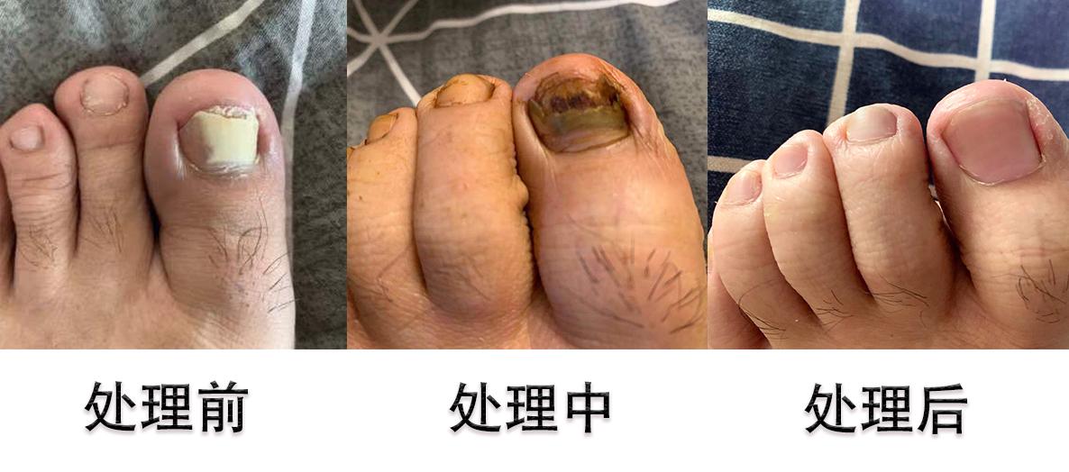 【灰指甲】灰指甲破茧重生,成功案例分享