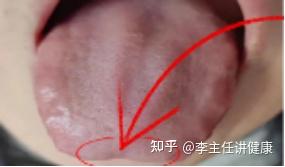 心虚舌面凹陷,脾虚舌面凹陷,肾虚舌面凹陷? - 知乎
