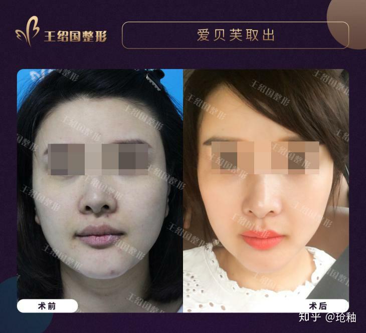 爱贝芙取出音速粒子共振技术