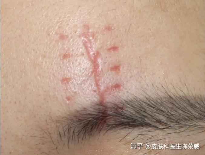 疤痕修复个人案例 - 知乎