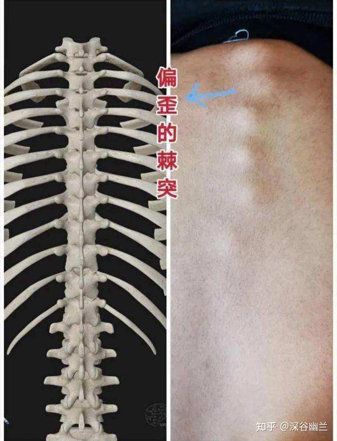 肩胛骨内侧疼的调理