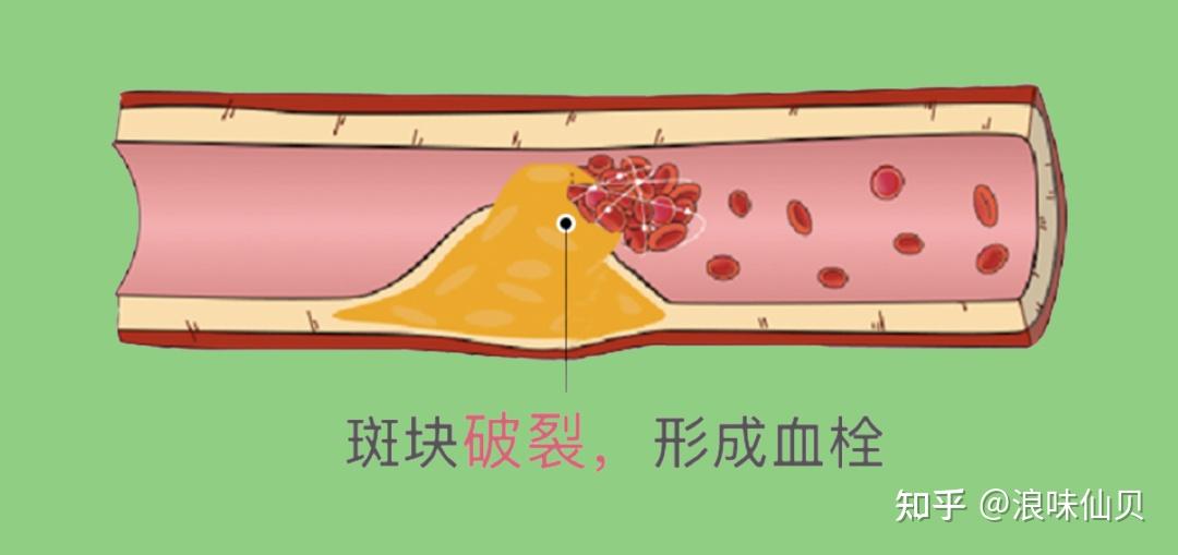 「斑块」破裂后触发了凝血机制形成了一个叫「血栓」的大血块把血管彻