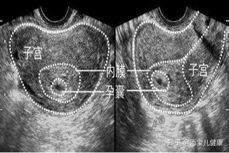 2,b超看不到宫内有孕囊.