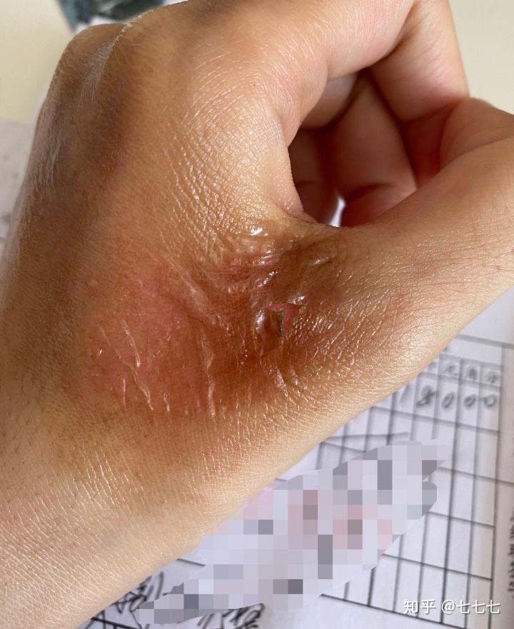 被开水烫了会留疤吗郁闷啊