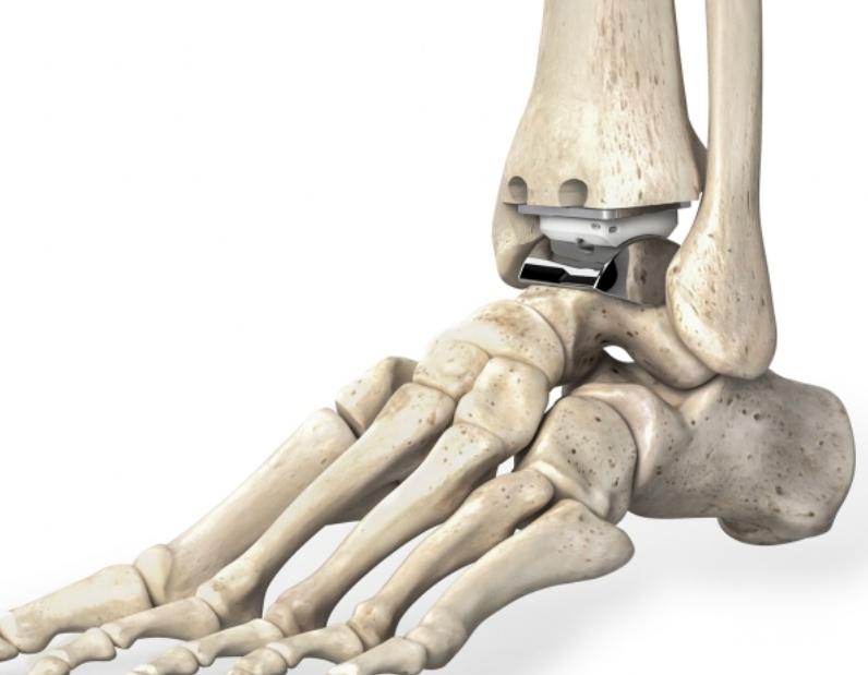 通过3d可视化,外科医生可以审视患者的踝关节状况,包括任何现有植入物