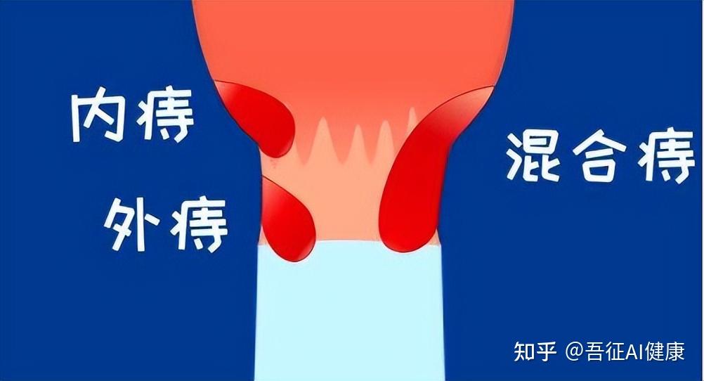 痔疮站不得坐不得，面对如此痛苦我该怎么办？ - 知乎